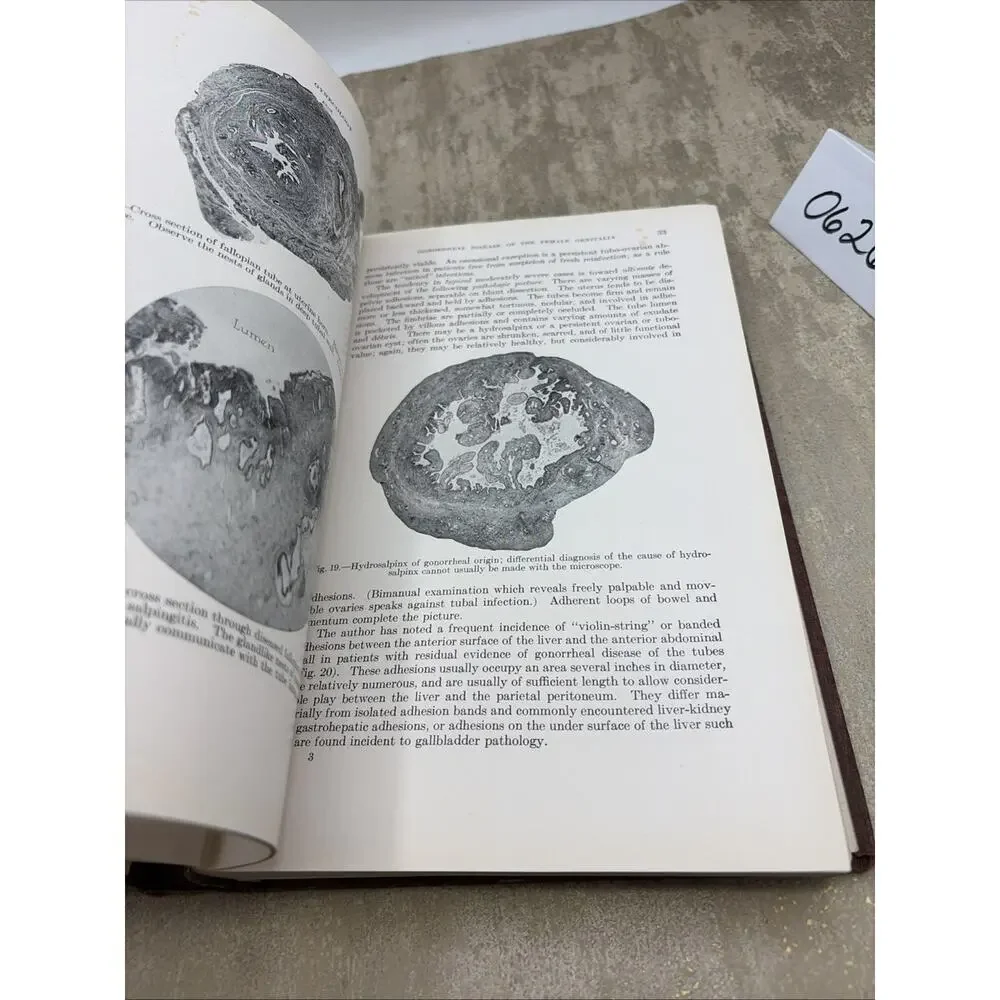 TEXTBOOK OF GYNECOLOGY 2nd Edition of 1931 By Arthur Hale Curtis